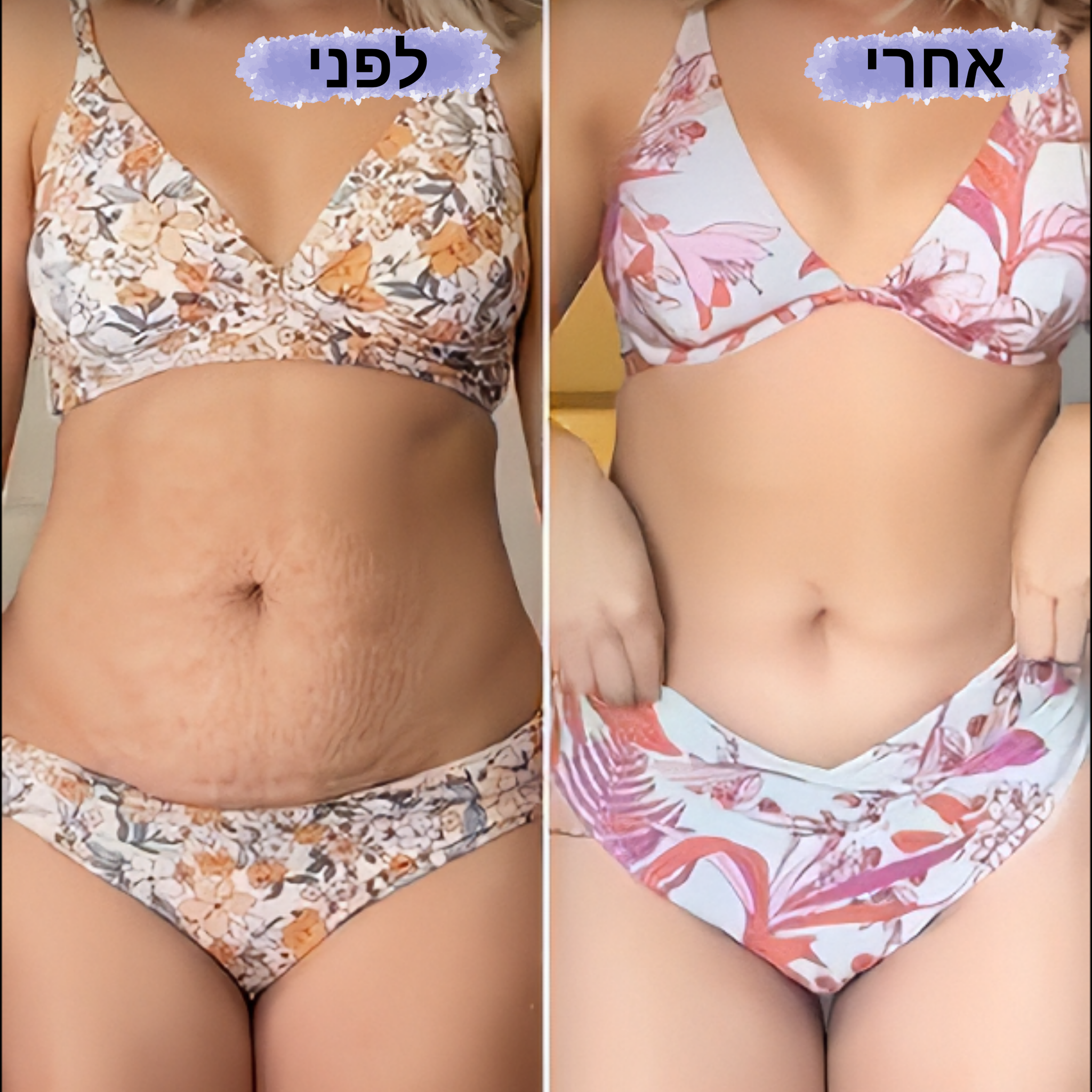 VERNA PRO - מכשיר לטיפול בצלוליט